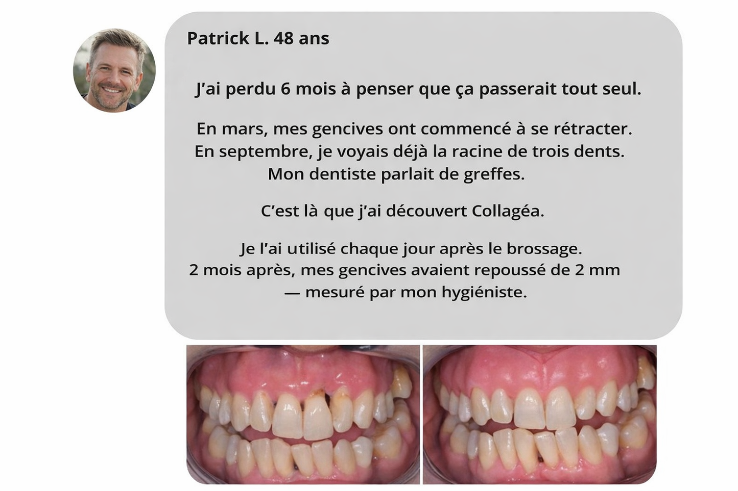 Collagéa™ I Poudre au collagène pour renforcer les gencives